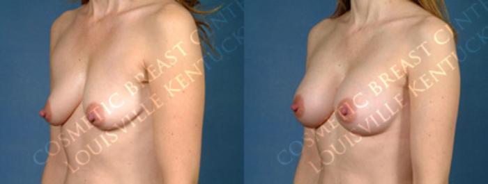 Before & After Enlargement - Silicone Case 160 View #2 View in Louisville & Lexington, KY