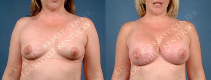 Before & After Enlargement - Silicone Case 171 View #1 View in Louisville & Lexington, KY