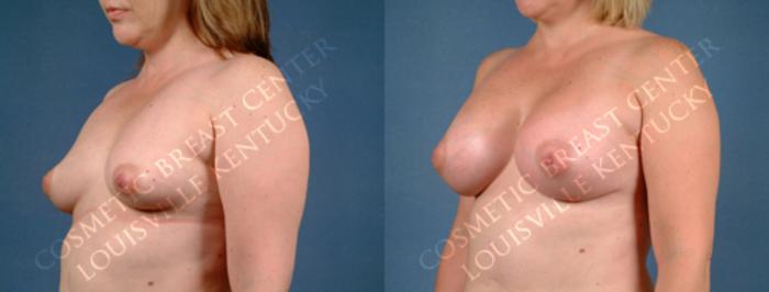 Before & After Enlargement - Silicone Case 171 View #2 View in Louisville & Lexington, KY