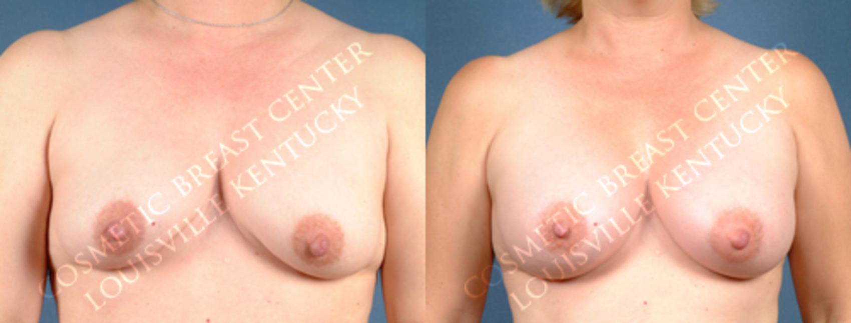 Before & After Enlargement - Silicone Case 172 View #1 View in Louisville & Lexington, KY