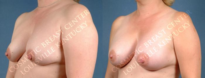 Before & After Enlargement - Silicone Case 172 View #2 View in Louisville & Lexington, KY