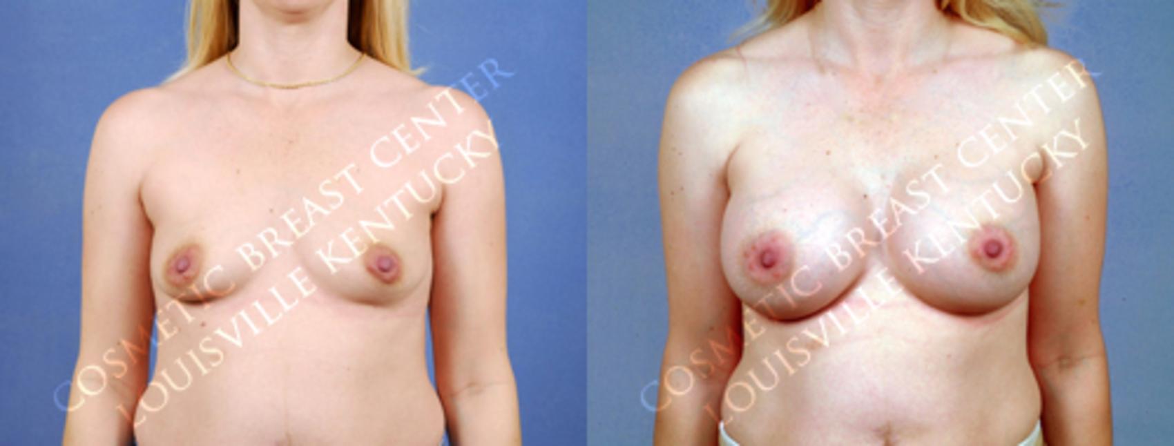 Before & After Enlargement - Silicone Case 173 View #1 View in Louisville & Lexington, KY