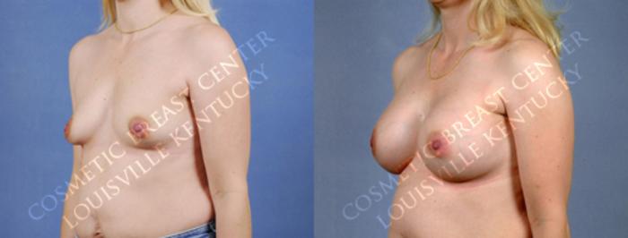 Before & After Enlargement - Silicone Case 173 View #2 View in Louisville & Lexington, KY