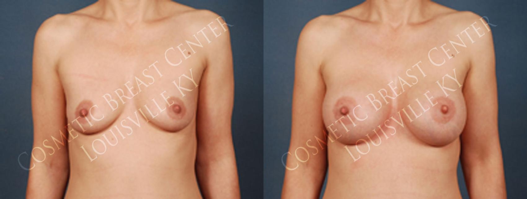 Before & After Enlargement - Silicone Case 195 View #1 View in Louisville & Lexington, KY