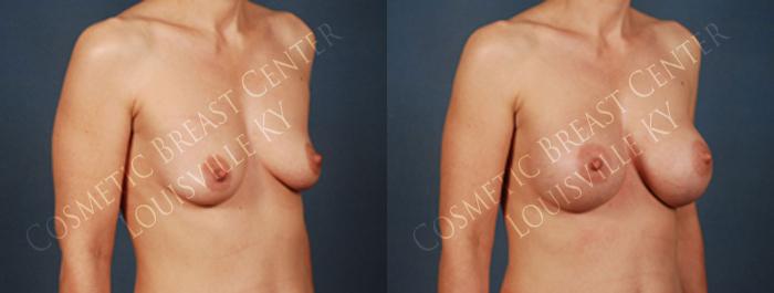 Before & After Enlargement - Silicone Case 195 View #2 View in Louisville & Lexington, KY