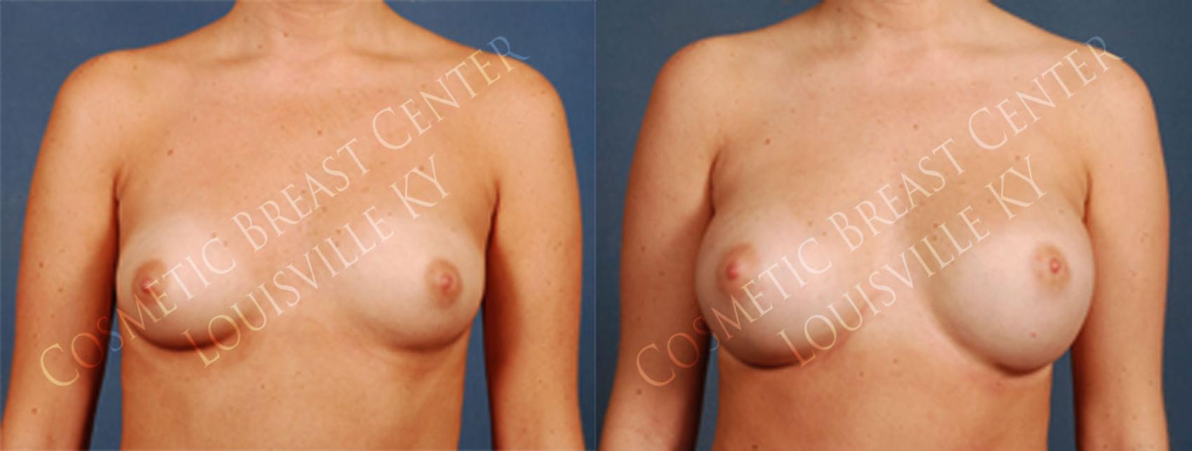 Before & After Enlargement - Silicone Case 198 View #1 View in Louisville & Lexington, KY