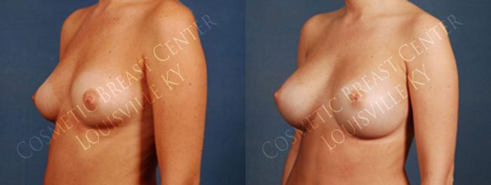 Before & After Enlargement - Silicone Case 198 View #2 View in Louisville & Lexington, KY