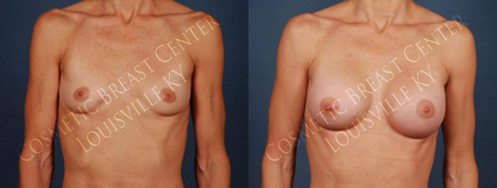 Before & After Enlargement - Silicone Case 200 View #1 View in Louisville & Lexington, KY
