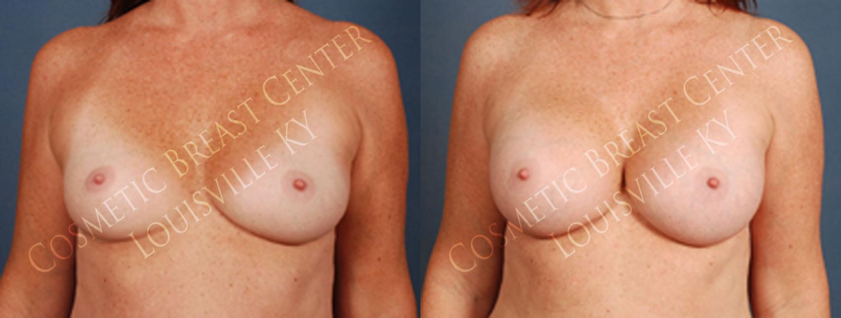 Before & After Enlargement - Silicone Case 201 View #1 View in Louisville & Lexington, KY