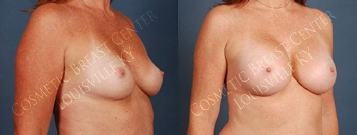 Before & After Enlargement - Silicone Case 201 View #2 View in Louisville & Lexington, KY