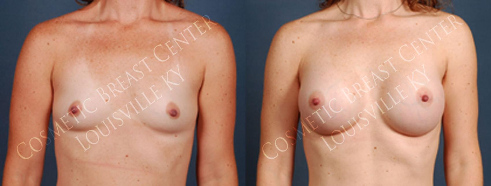Before & After Enlargement - Silicone Case 202 View #1 View in Louisville & Lexington, KY
