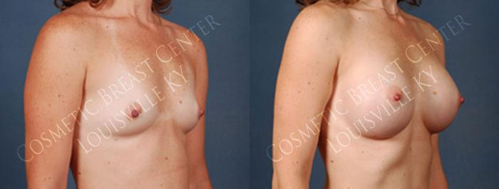 Before & After Enlargement - Silicone Case 202 View #2 View in Louisville & Lexington, KY