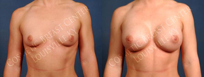 Before & After Enlargement - Silicone Case 203 View #1 View in Louisville & Lexington, KY