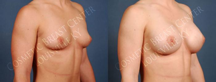 Before & After Enlargement - Silicone Case 203 View #2 View in Louisville & Lexington, KY