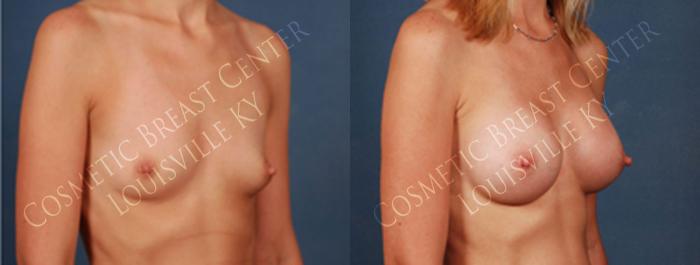 Before & After Enlargement - Silicone Case 205 View #2 View in Louisville & Lexington, KY