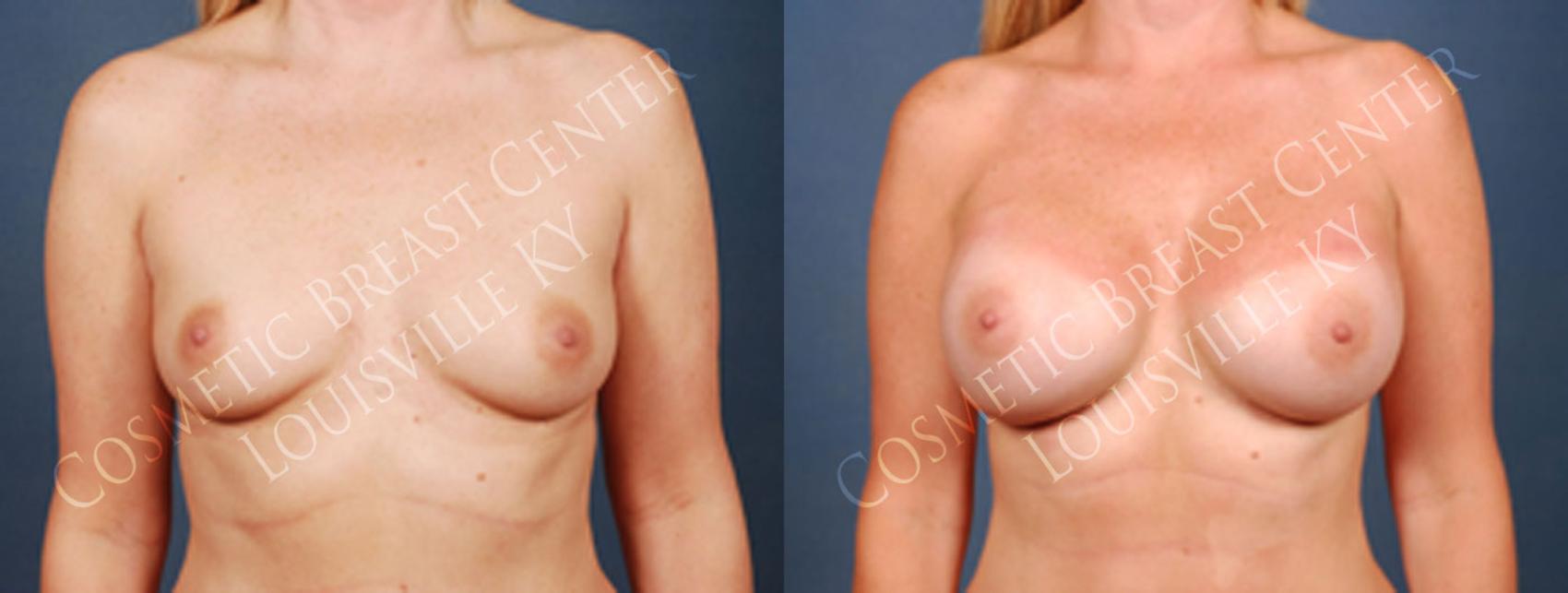 Before & After Enlargement - Silicone Case 208 View #1 View in Louisville & Lexington, KY