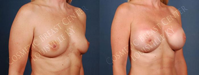 Before & After Enlargement - Silicone Case 208 View #2 View in Louisville & Lexington, KY