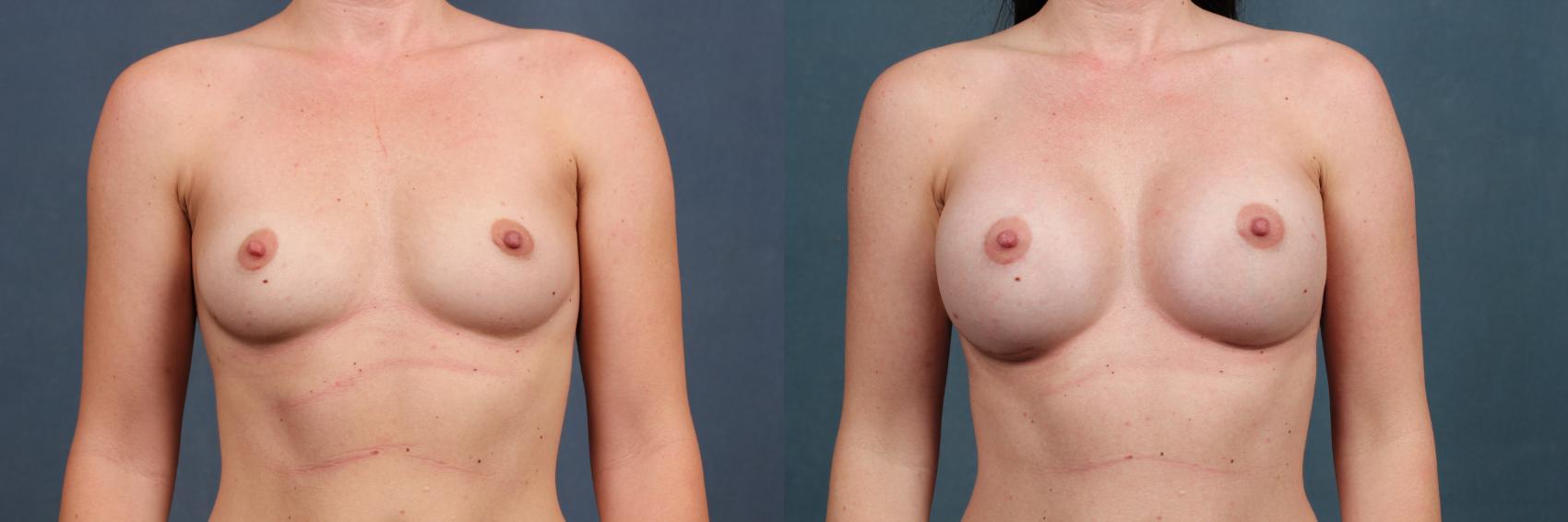 Before & After Enlargement - Silicone Case 273 View #1 View in Louisville & Lexington, KY