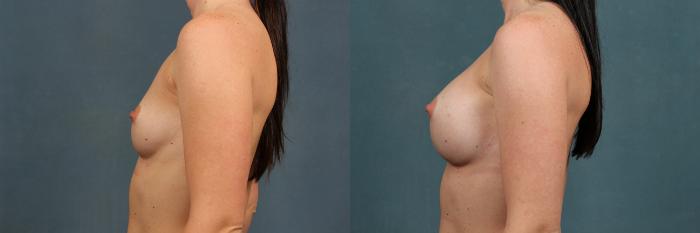 Before & After Enlargement - Silicone Case 273 View #2 View in Louisville & Lexington, KY