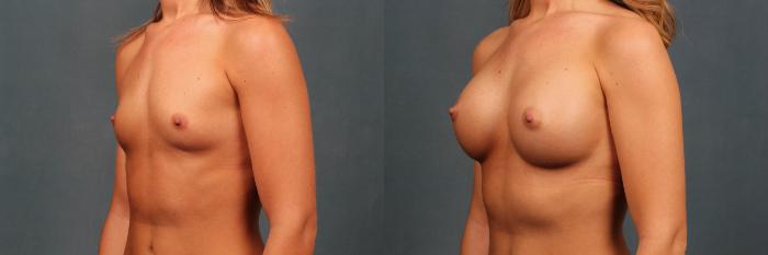 Before & After Enlargement - Silicone Case 287 View #2 View in Louisville & Lexington, KY