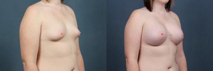 Before & After Enlargement - Silicone Case 288 View #1 View in Louisville & Lexington, KY