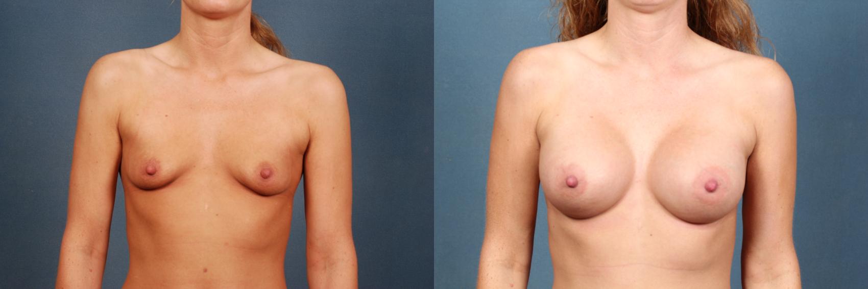 Before & After Enlargement - Silicone Case 289 View #1 View in Louisville & Lexington, KY