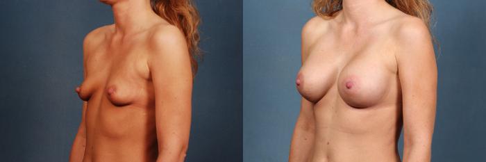 Before & After Enlargement - Silicone Case 289 View #2 View in Louisville & Lexington, KY