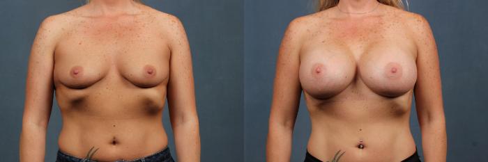 Before & After Enlargement - Silicone Case 291 View #1 View in Louisville & Lexington, KY