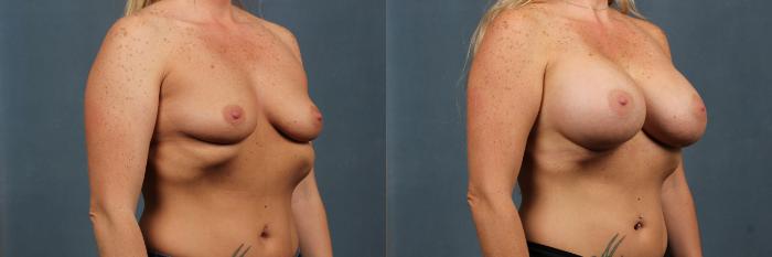 Before & After Enlargement - Silicone Case 291 View #2 View in Louisville & Lexington, KY