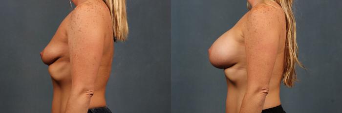 Before & After Enlargement - Silicone Case 291 View #3 View in Louisville & Lexington, KY