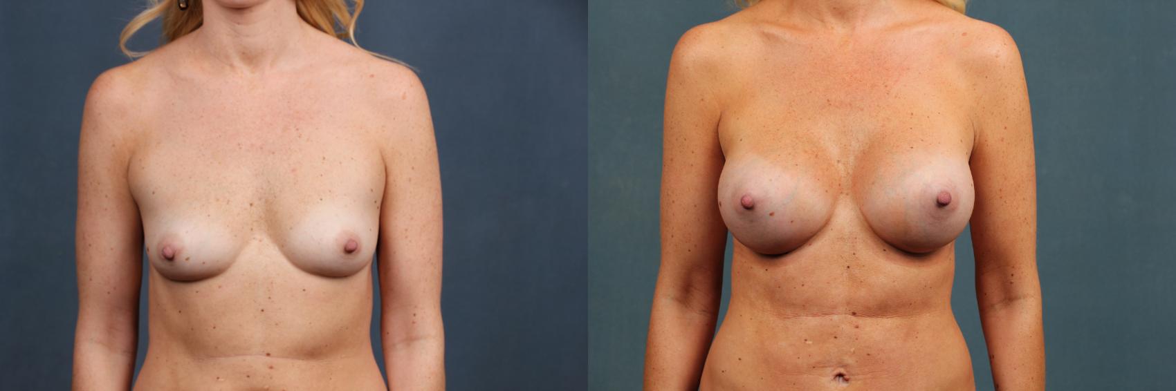 Before & After Enlargement - Silicone Case 292 View #1 View in Louisville & Lexington, KY