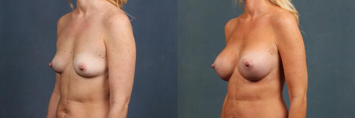 Before & After Enlargement - Silicone Case 292 View #2 View in Louisville & Lexington, KY