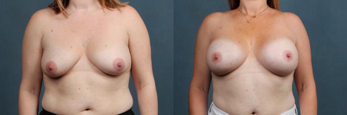 Before & After Enlargement - Silicone Case 294 View #1 View in Louisville & Lexington, KY