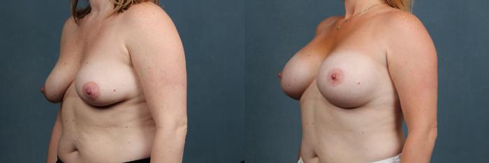 Before & After Enlargement - Silicone Case 294 View #2 View in Louisville & Lexington, KY