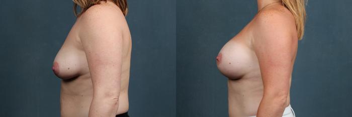 Before & After Enlargement - Silicone Case 294 View #3 View in Louisville & Lexington, KY