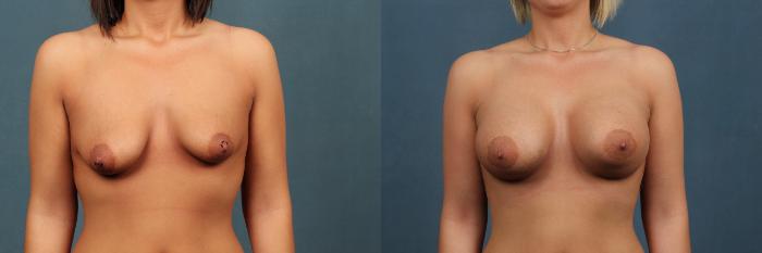 Before & After Enlargement - Silicone Case 297 View #1 View in Louisville & Lexington, KY