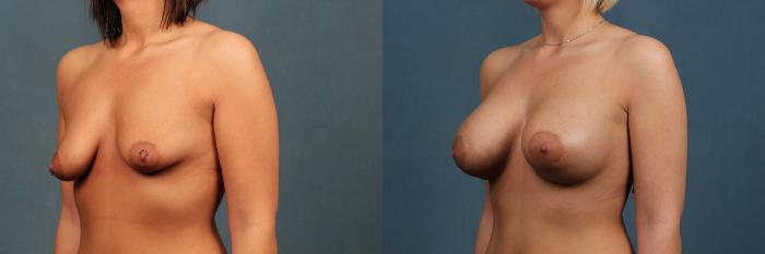 Before & After Enlargement - Silicone Case 297 View #3 View in Louisville & Lexington, KY