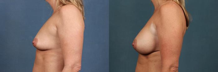 Before & After Enlargement - Silicone Case 298 View #3 View in Louisville & Lexington, KY