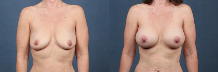 Before & After Enlargement - Silicone Case 299 View #1 View in Louisville & Lexington, KY