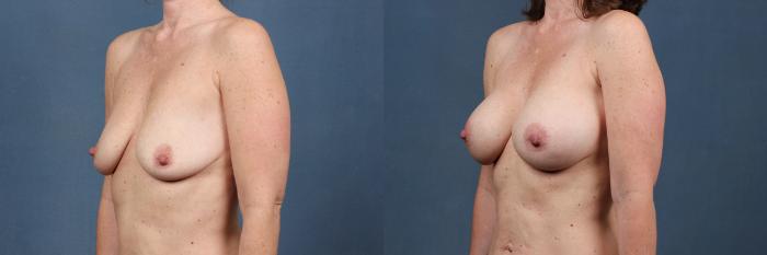 Before & After Enlargement - Silicone Case 299 View #2 View in Louisville & Lexington, KY