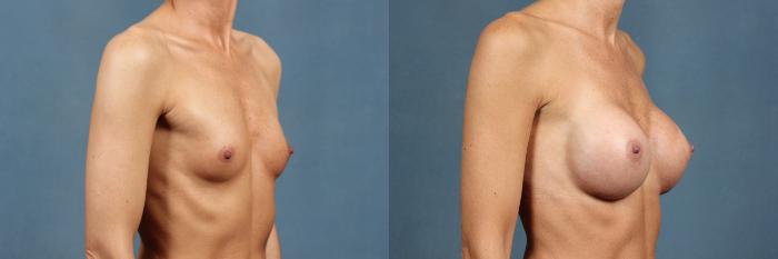 Before & After Enlargement - Silicone Case 300 View #2 View in Louisville & Lexington, KY