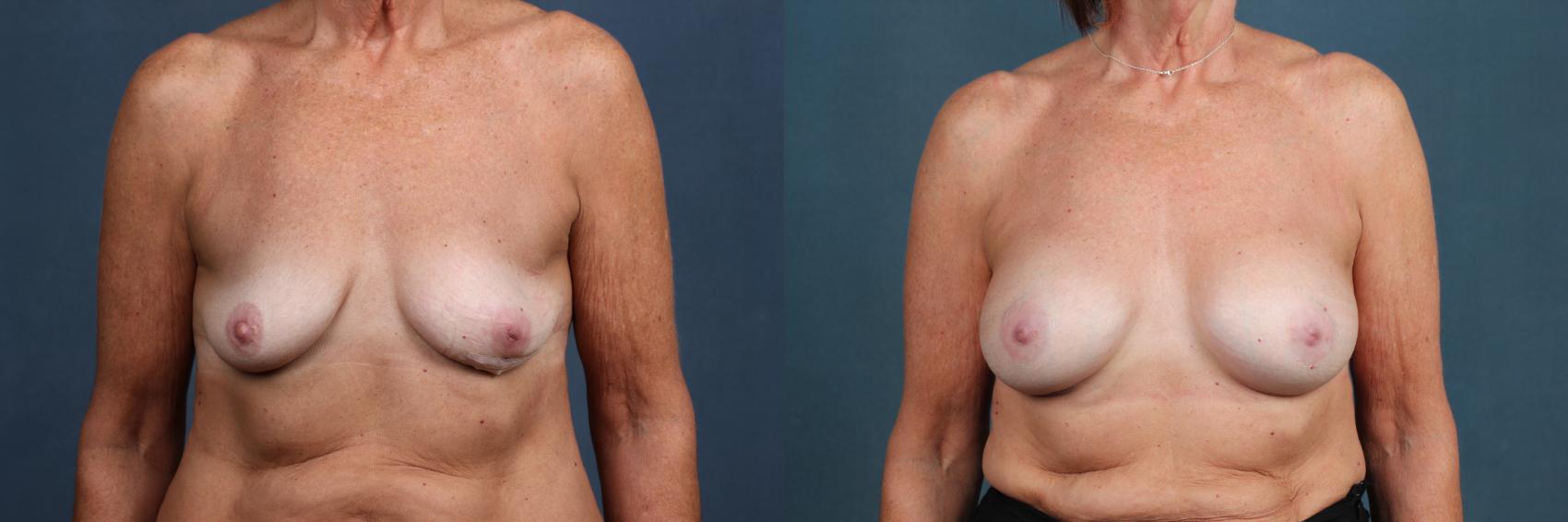 Before & After Enlargement - Silicone Case 301 View #1 View in Louisville & Lexington, KY