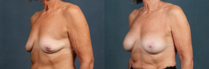 Before & After Enlargement - Silicone Case 301 View #2 View in Louisville & Lexington, KY