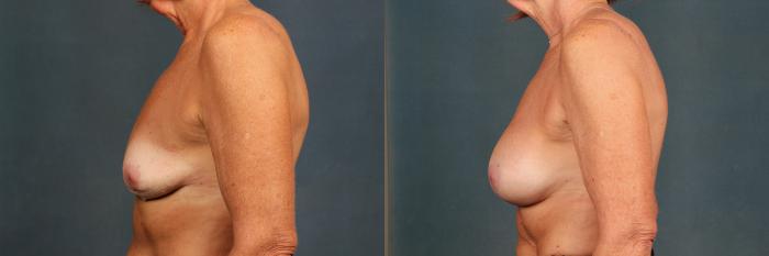 Before & After Enlargement - Silicone Case 301 View #3 View in Louisville & Lexington, KY