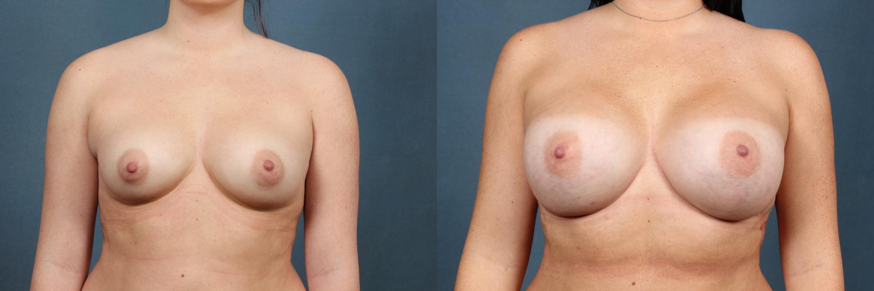 Before & After Enlargement - Silicone Case 302 View #1 View in Louisville & Lexington, KY