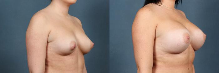 Before & After Enlargement - Silicone Case 302 View #2 View in Louisville & Lexington, KY