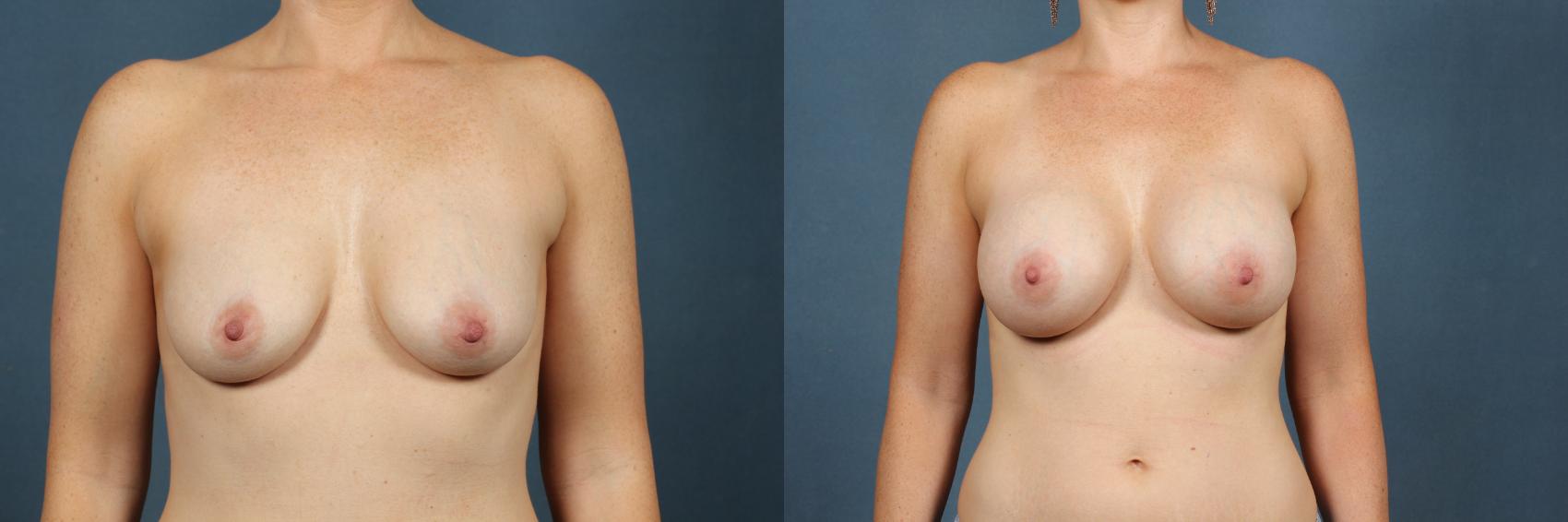 Before & After Enlargement - Silicone Case 304 View #1 View in Louisville & Lexington, KY