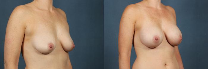 Before & After Enlargement - Silicone Case 304 View #2 View in Louisville & Lexington, KY