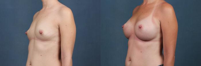 Before & After Enlargement - Silicone Case 305 View #3 View in Louisville & Lexington, KY