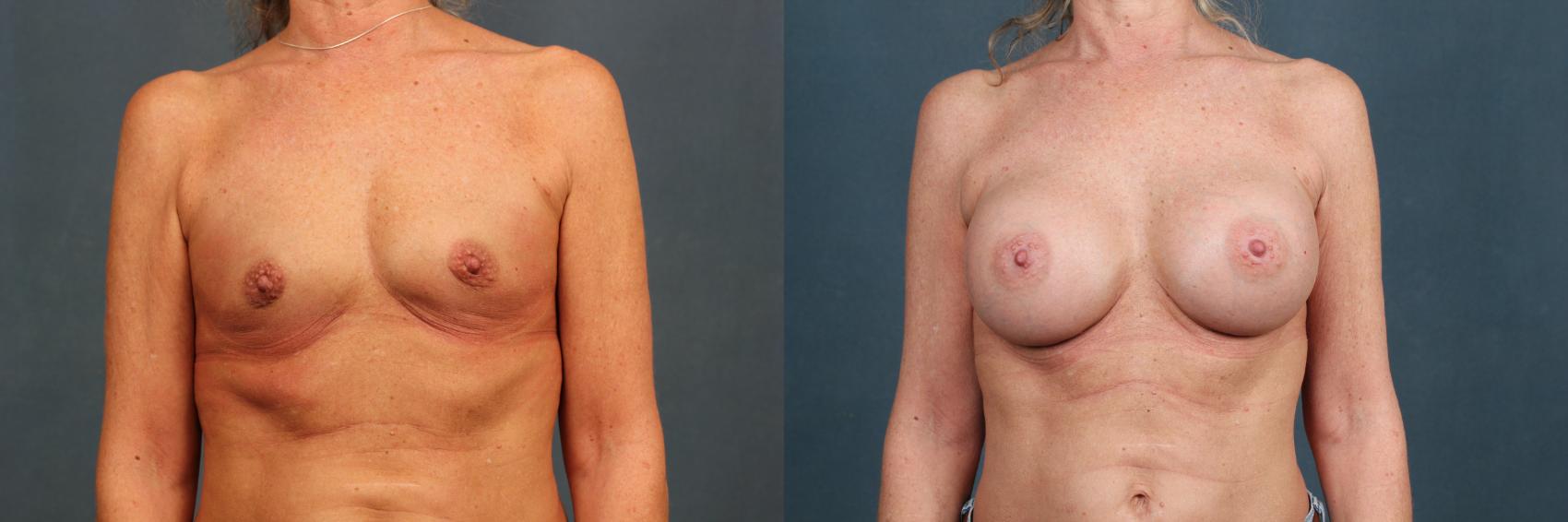 Before & After Enlargement - Silicone Case 307 View #1 View in Louisville & Lexington, KY